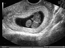 C-Section Injury Lawyer